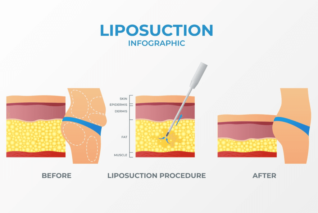 How Are Fats Digested in Our Bodies?